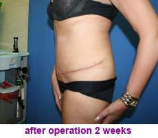 plastic-surgery-tummy-tuck
